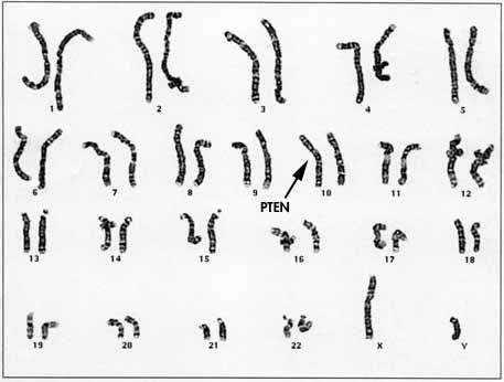 PTEN gene.